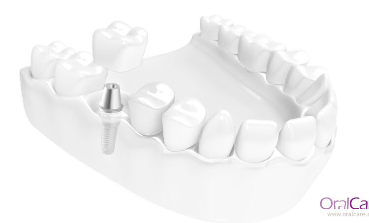 En manglende tann kan erstattes med tannimplantat og krone.