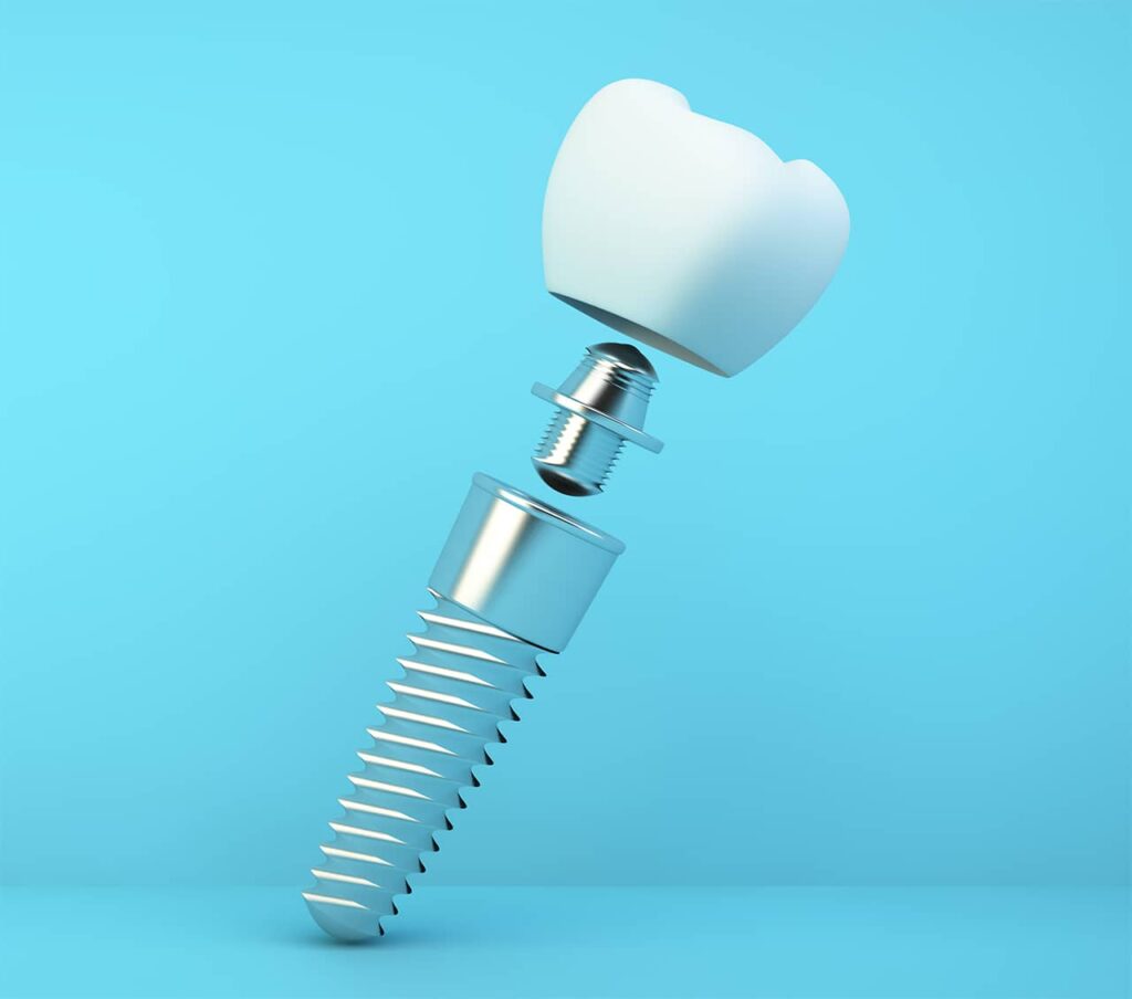 Illustrasjon av tannimplantat med distanse og implantatkrone