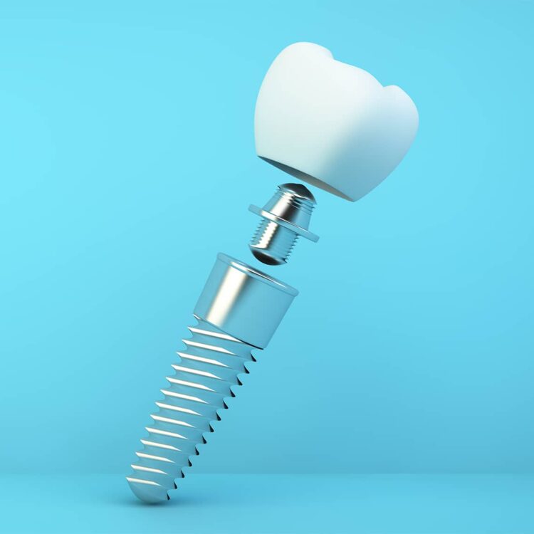 Illustrasjon av tannimplantat med distanse og implantatkrone