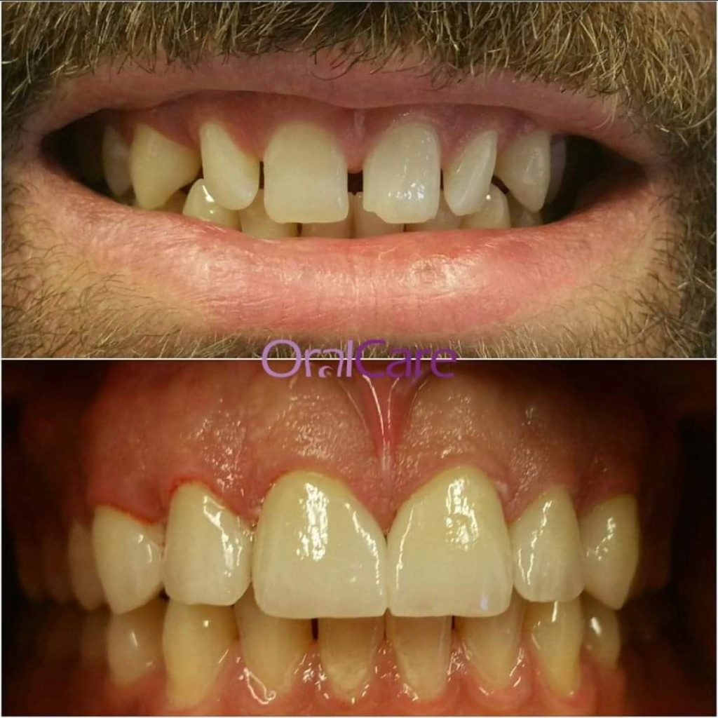 Før- og etterbilde behandling hos OralCare
