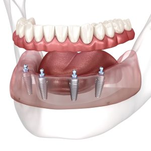 Removable,Mandibular,Prosthesis,All,On,4,System,Supported,By,Implants.